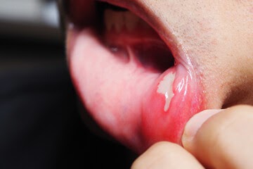 How To Heal A Canker Sore?