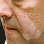 vitiligo treatment Profile Picture