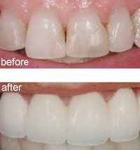 Porcelain Crowns Bridges Veneers Dental Lounge Eltham